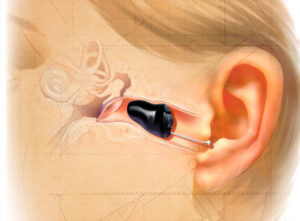 Benefits of Hearing Aids in Age-related Hearing Loss