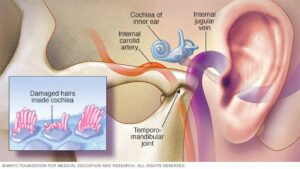 Understanding Tinnitus: A Perception of Sound in Ears