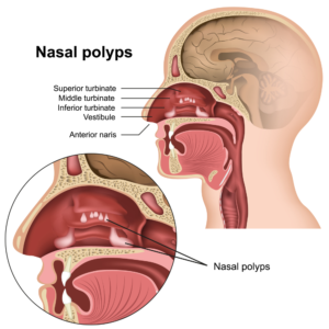 Nasal Polyposis: Is It Fungus Inside My Nose?
