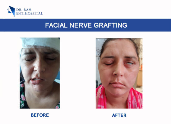 facial nerve grafting