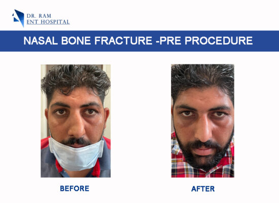 nasal bone fracture -pre procedure