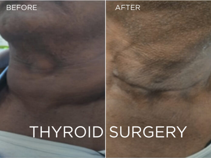 Thyroid Surgery After and Before