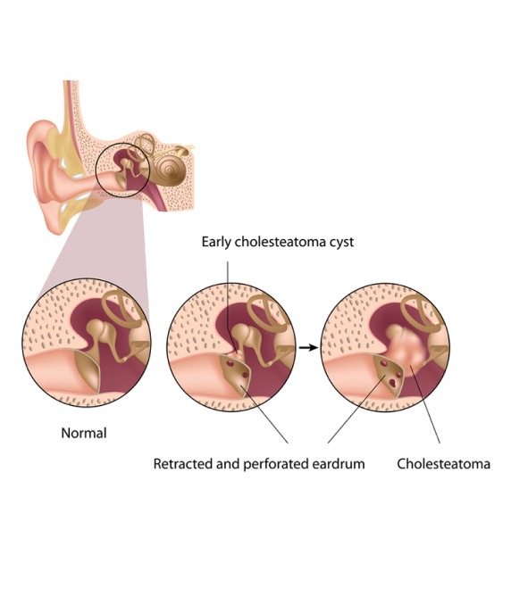 Causes of Cholesteatoma