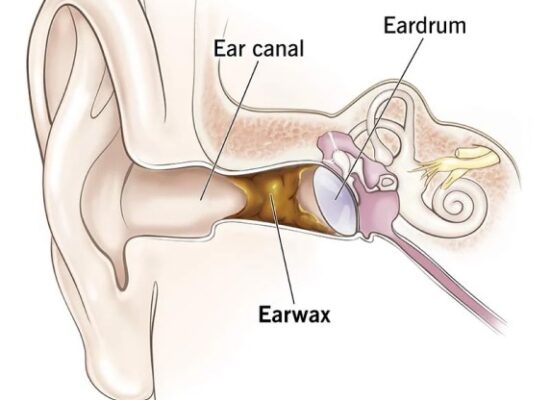 Causes of Impacted Ear wax