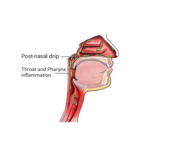 Causes of Post-Nasal Drip