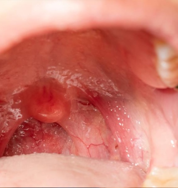 Causes of Tonsillitis and Adenoiditis