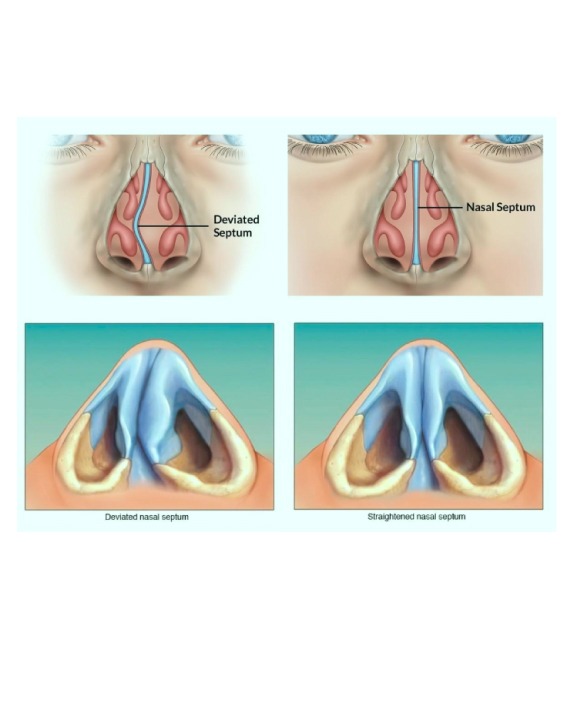 Symptoms of Nasal Blockage
