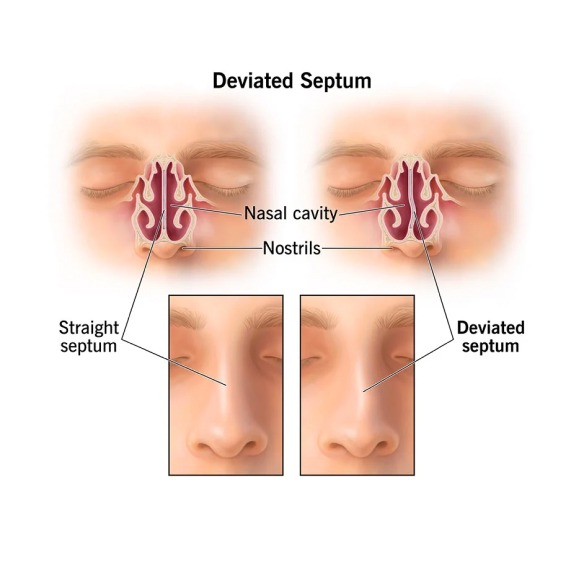Symptoms of Nasal Blockage