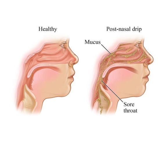 Symptoms of Post-Nasal Drip