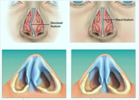 Deviated Nasal Septum