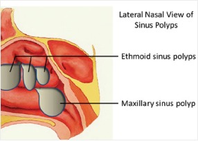 Nasal Polyps and Tumors