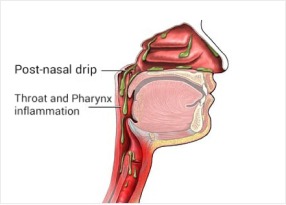 Post-Nasal Drip