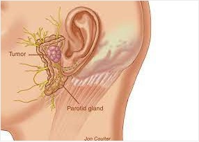 Surgery for Tumors of Parotid and Submandibular Gland
