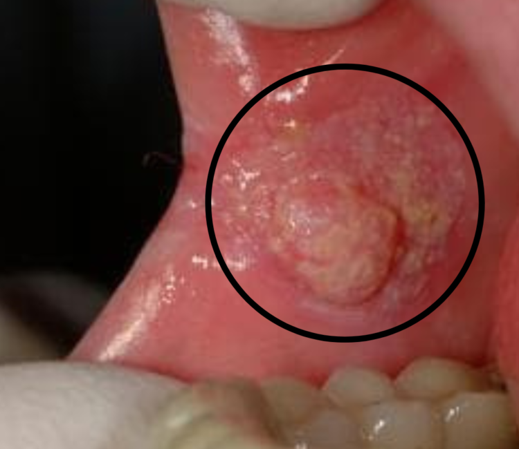 Oral Cancer Mucosa