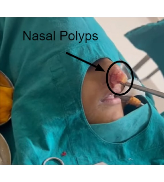 Nasal Polyps and Tumors