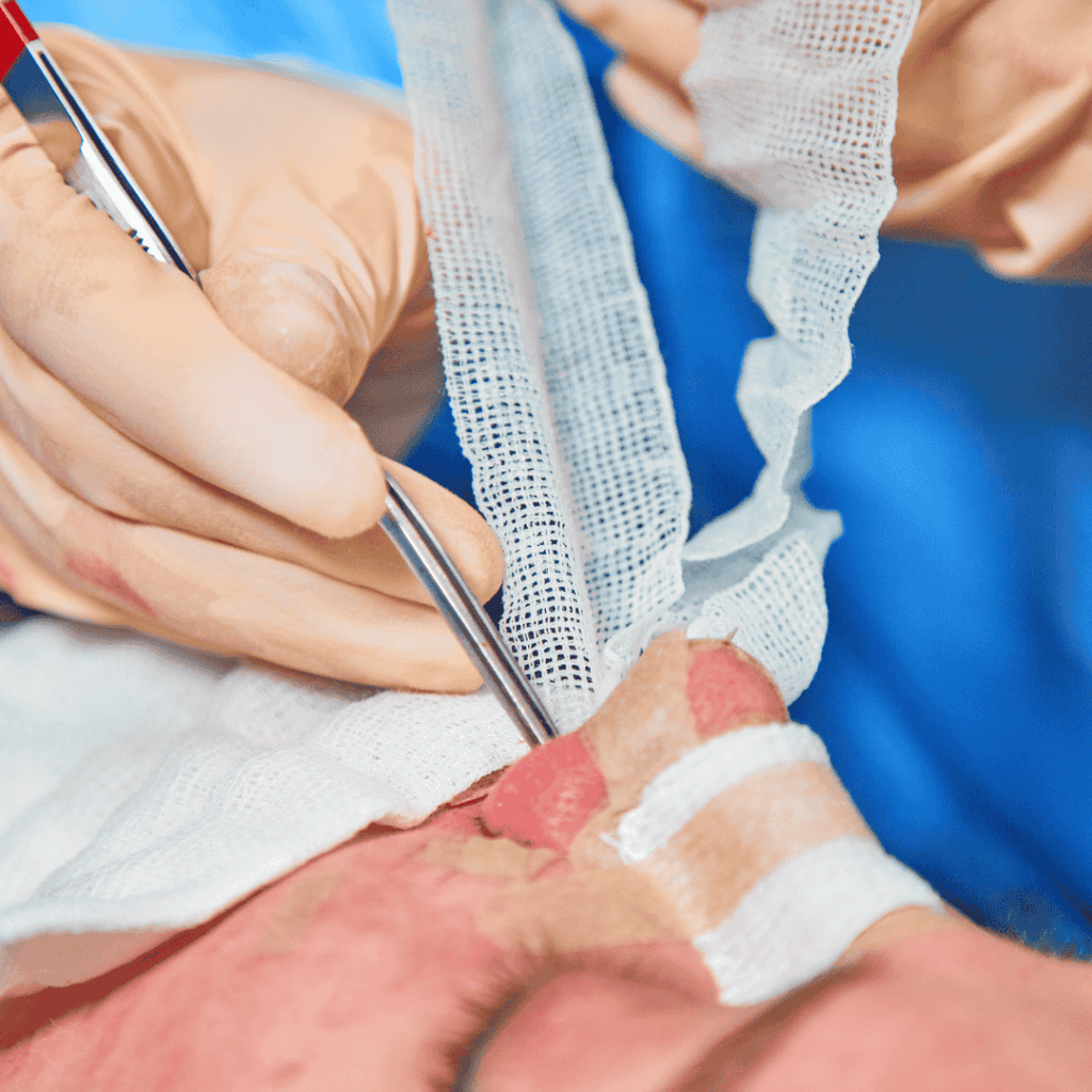 Balloon Septers Expert Nasal Septum Surgery | Endoscopic Septoplasty Surgery at Dr. Ram ...