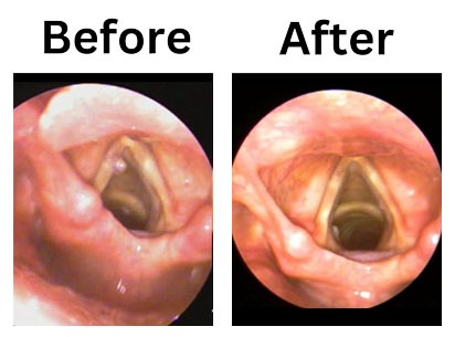 microscopic-surgery-for-hoarseness