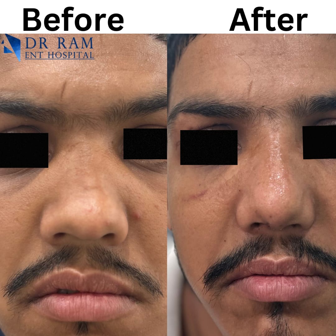 Rhinoplasty