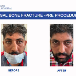 Before and after images of a male patient treated for nasal bone fracture showing facial improvement post-procedure