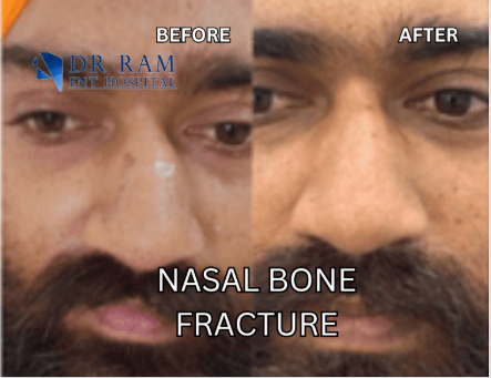 Facial correction results for nasal fracture patient by Dr. Ram ENT specialists