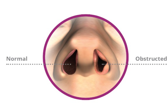 deviated nasal septum treatment