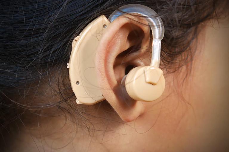 Cochlear implant device fitted behind ear for severe hearing loss